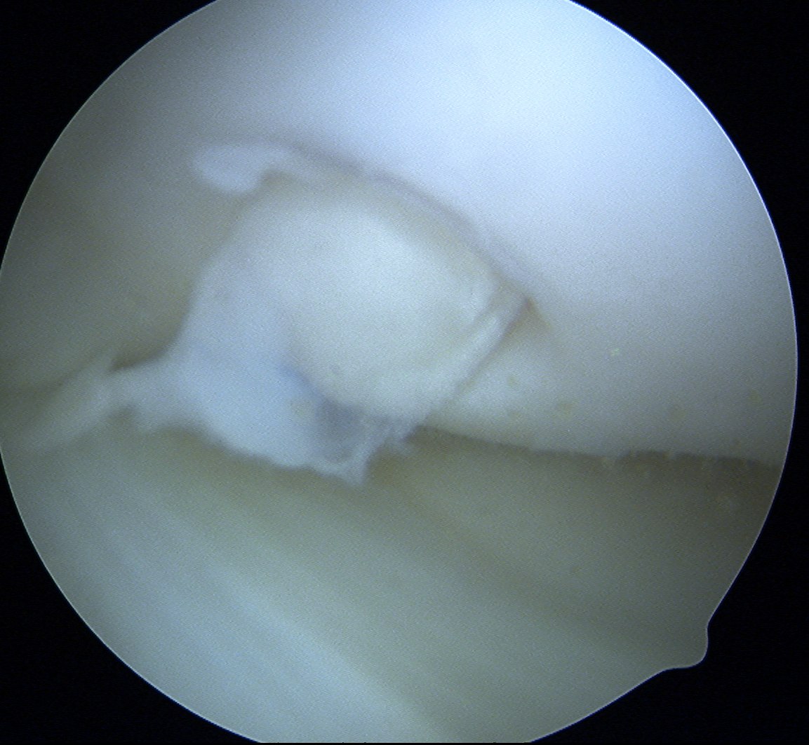 Mosaicplasty Plug in situ